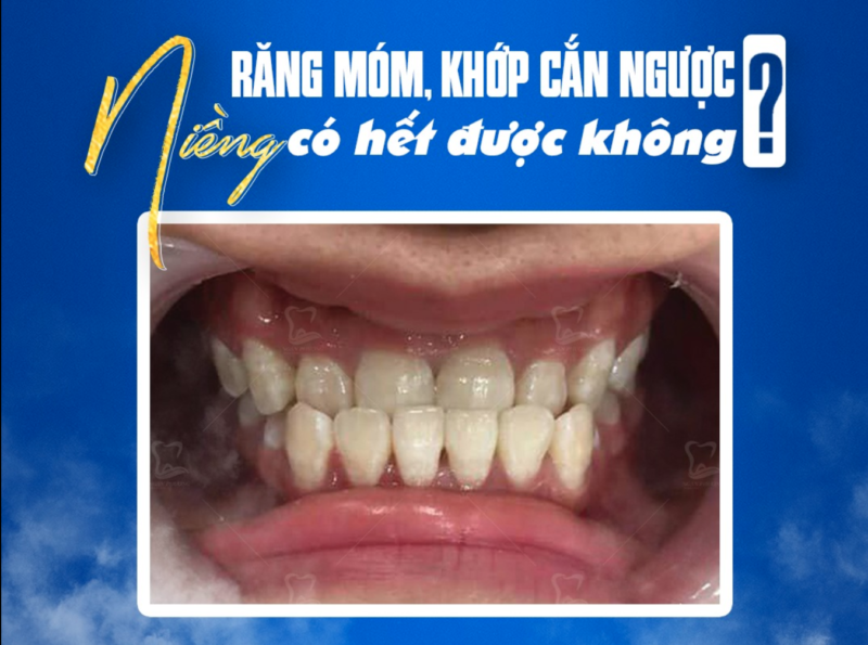 niềng răng có hết móm được không