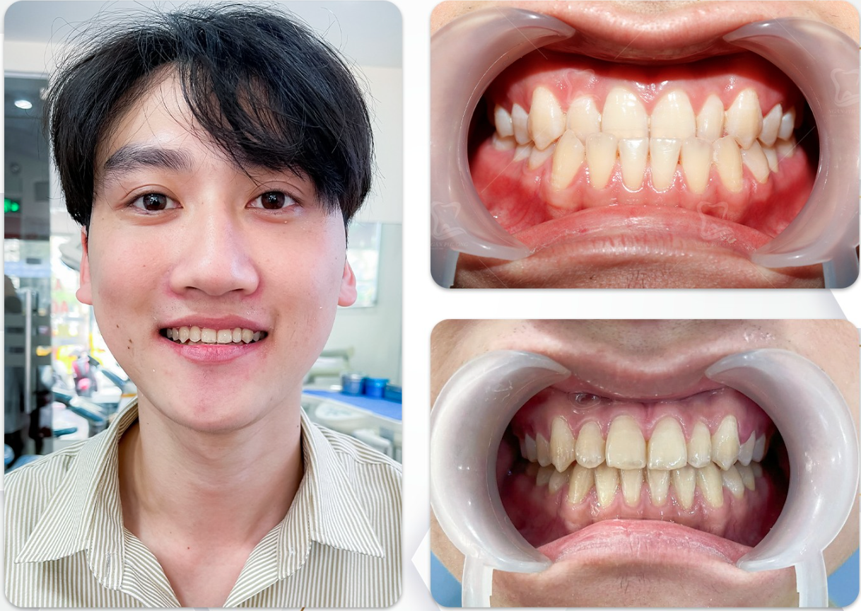 niềng răng cải thiện móm