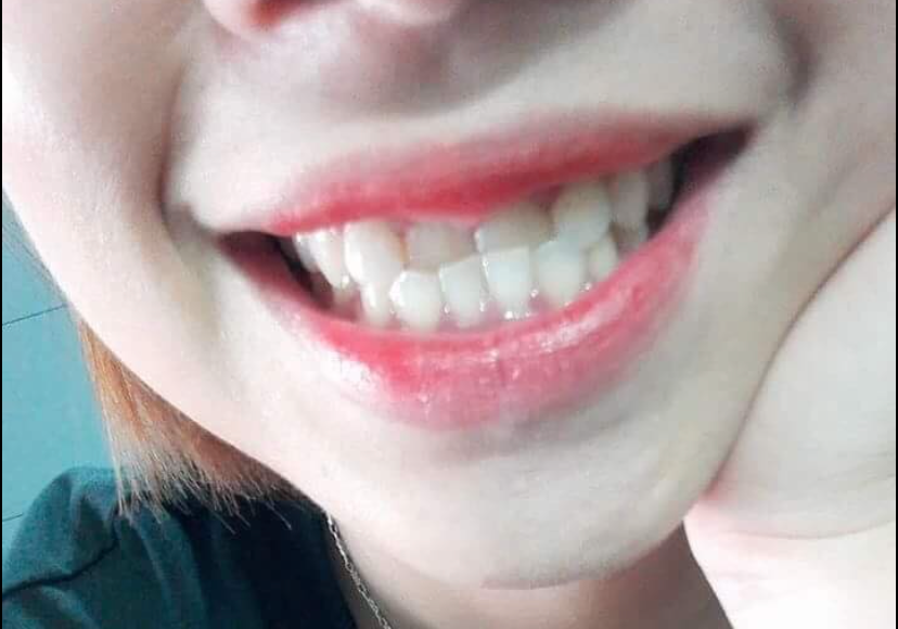 phẫu thuật hàm điều trị móm răng