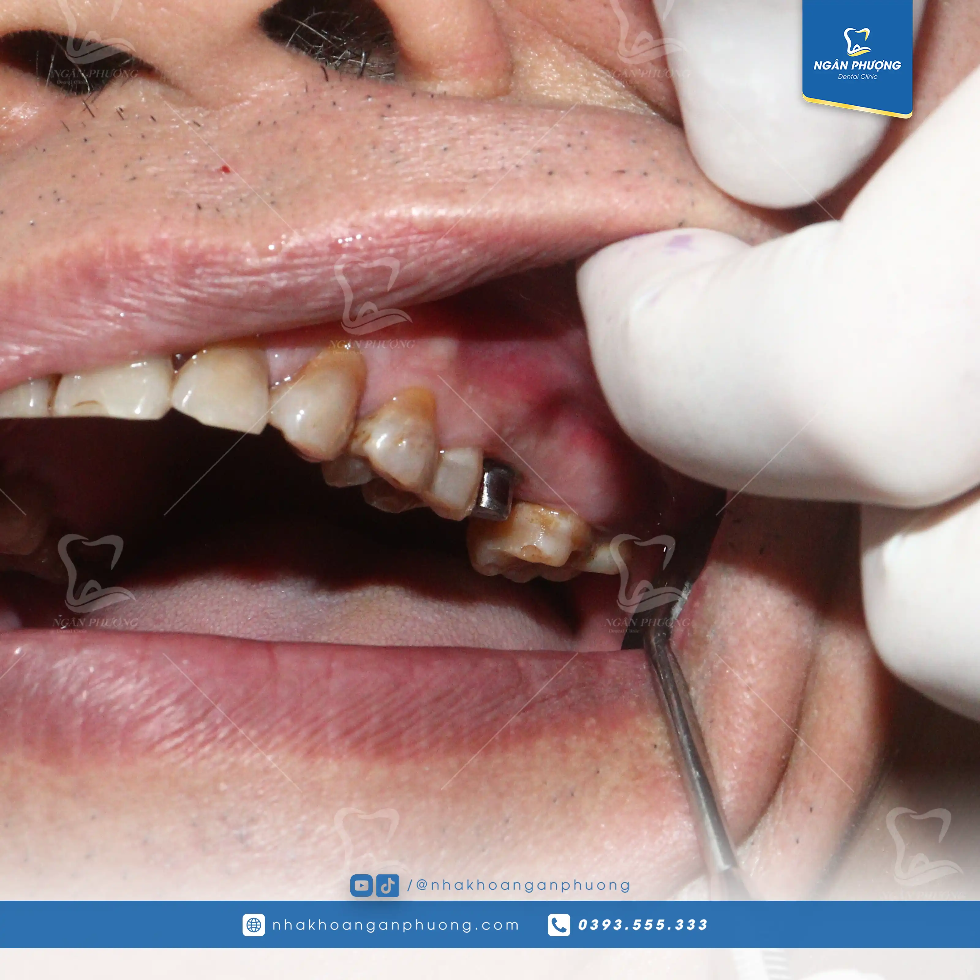 hình ảnh trụ implant đã được cấy ghép thành công