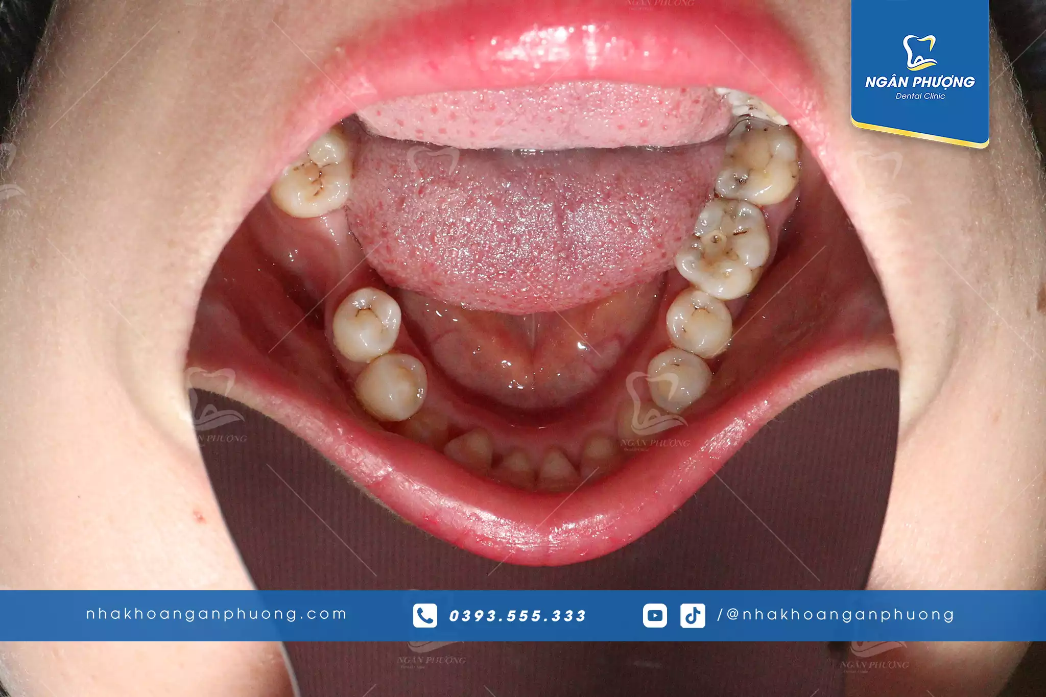 hình ảnh miệng một khách hàng cần đến trồng răng implant