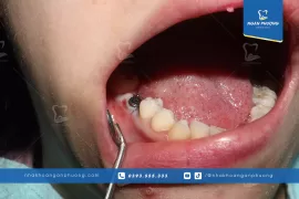 Không Thể Trồng Răng Implant, tại sao?