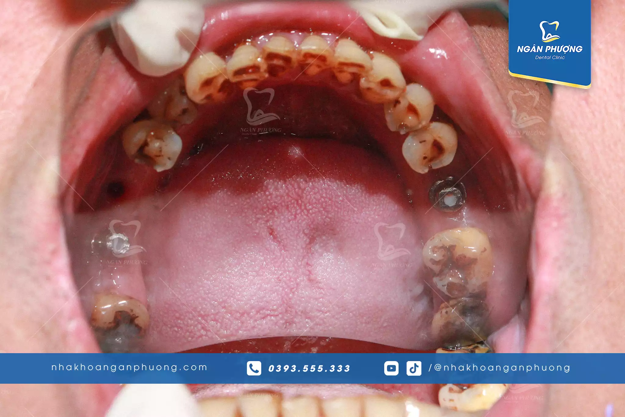 sâu răng nặng có thể dẫn đến mất răng
