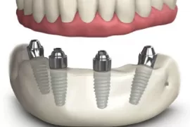 Trồng răng Implant All on 4: Giải pháp phục hồi toàn diện hàm răng chỉ với 4 trụ implant