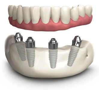 trồng răng implant all on 4