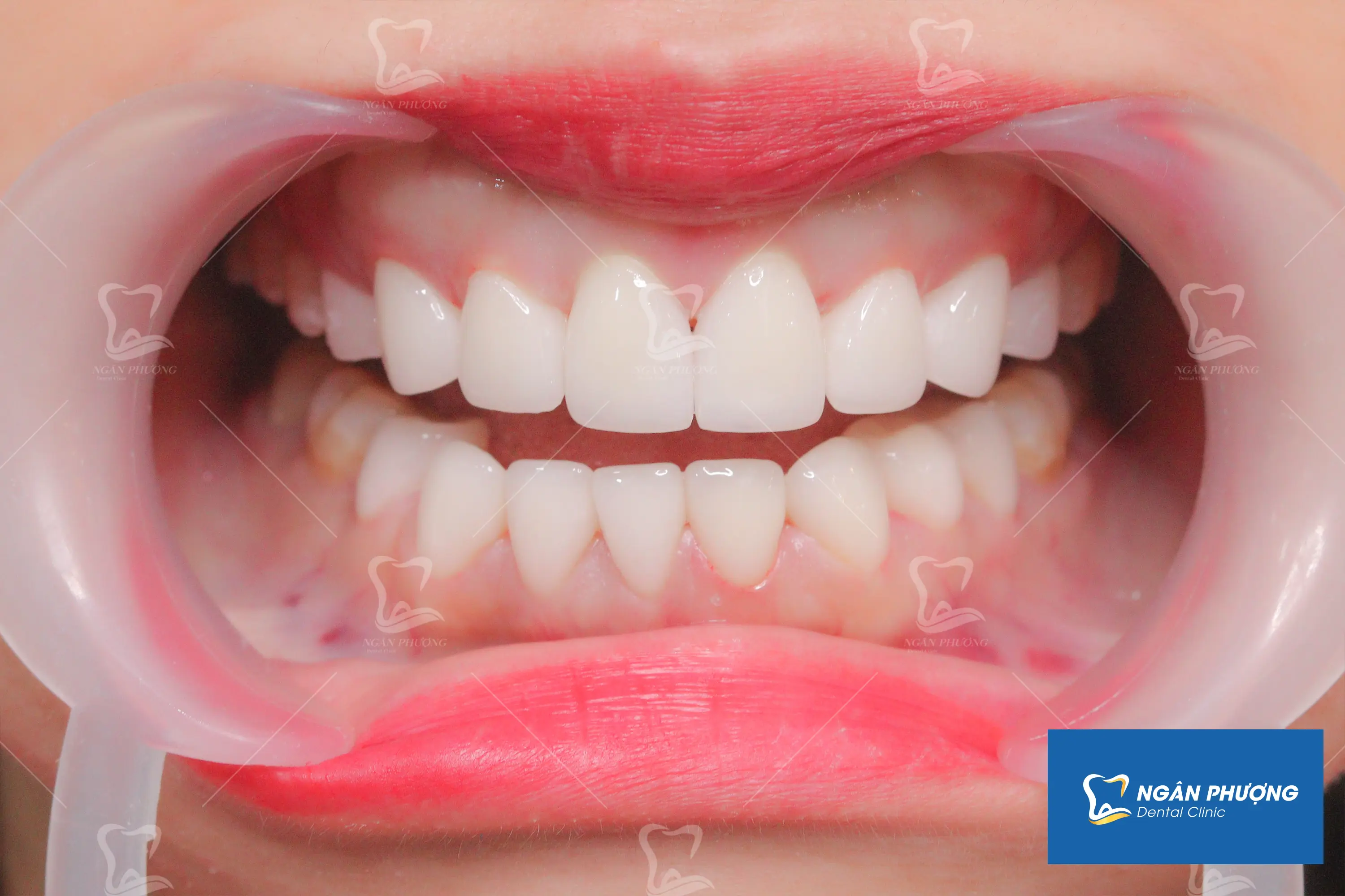 Tấm ảnh này miêu tả hàm răng của một phụ nữ trưởng thành, với 16 răng đã được phục hình bằng veneer sứ. Các veneer sứ này có màu trắng sáng, bóng, tạo ra một nụ cười rạng rỡ và đồng đều. Răng veneer được chế tác tỉ mỉ để phù hợp hoàn hảo với hình dáng và kích cỡ tự nhiên của răng, đồng thời mang lại vẻ thẩm mỹ cao. Ảnh tập trung vào hàm răng, chiếu rõ từng chi tiết của các răng đã được dán veneer, thể hiện sự thay đổi rõ rệt so với hàm răng tự nhiên trước đó.