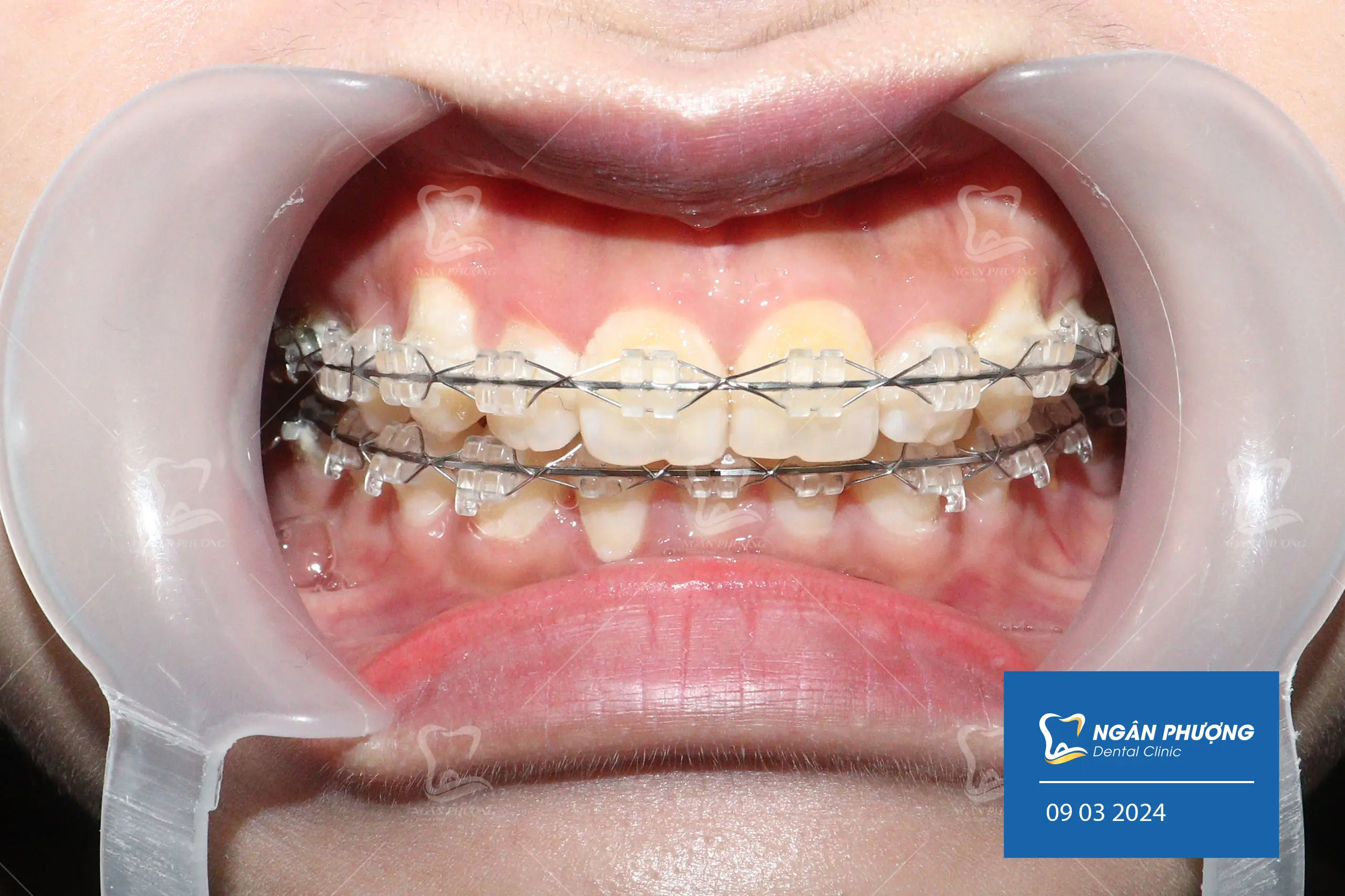 Tấm ảnh cho thấy hàm răng của một phụ nữ trưởng thành, nổi bật với mắc cài pha lê sáng bóng được gắn trên các răng. Mắc cài này tạo ra một hiệu ứng thẩm mỹ độc đáo, kết hợp giữa vẻ đẹp và chức năng chỉnh nha. Răng được chăm sóc kỹ lưỡng, trắng sáng, và mắc cài pha lê thêm một chút lấp lánh cho nụ cười. Các mắc cài được gắn cẩn thận trên mỗi răng, phản chiếu ánh sáng và tạo ra một hiệu ứng đẹp mắt, thể hiện sự kết hợp giữa công nghệ chỉnh nha và yếu tố thẩm mỹ.