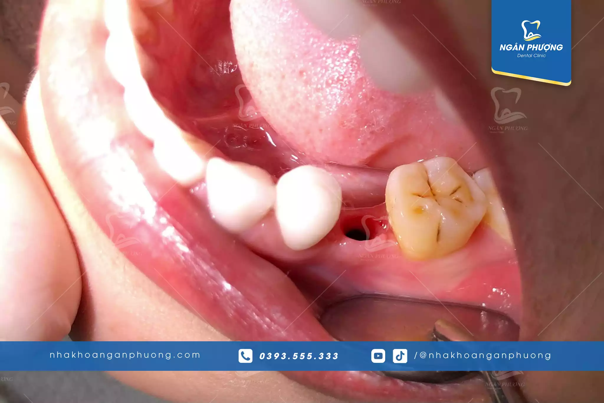 răng sau khi đục lỗ chuẩn bị trồng implant