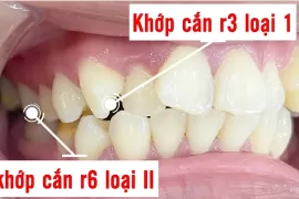 Khớp cắn loại 2 là gì