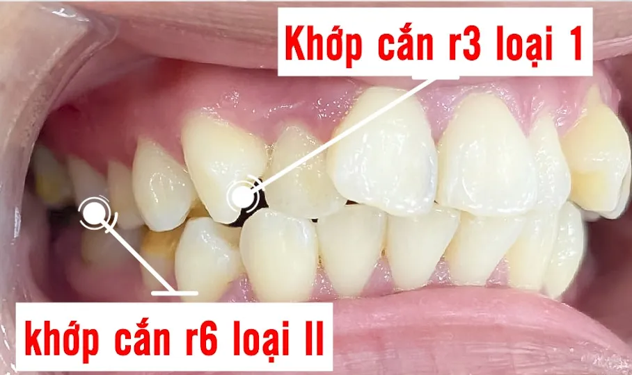 khớp cắn loại 2