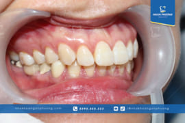 Niềng Răng Hô bằng Mắc Cài Kim Loại có hiệu quả không?