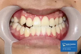 Khớp Cắn Loại 3 và Bất Tiện Của Tình Trạng Này