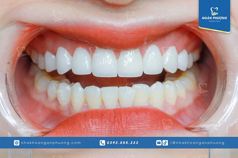 răng dán sứ veneer
