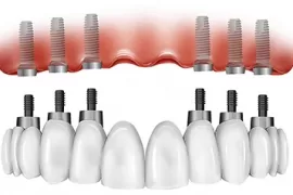 Nhược Điểm Của Trồng Răng All-on-6