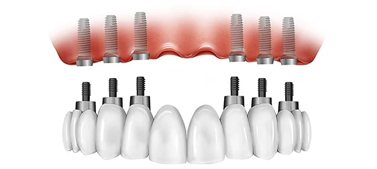 nhược điểm của trồng răng all-on-6
