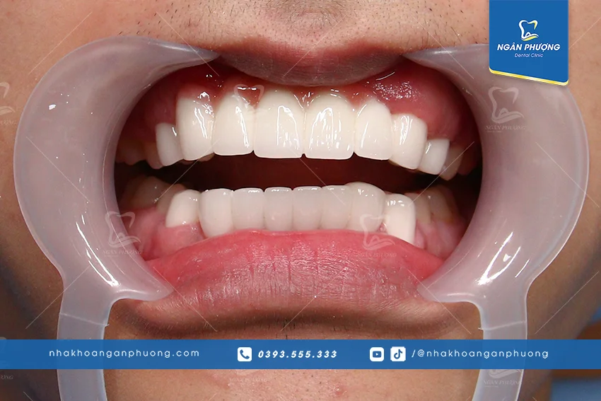 nhược điểm của cầu răng sứ