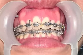 Công Dụng Của Mắc Cài Trong Chỉnh Nha