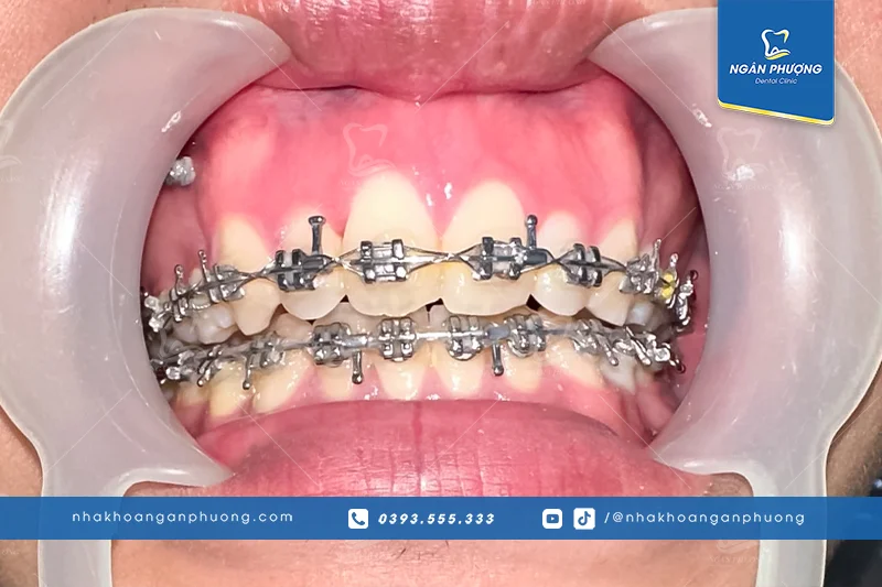 công dụng của mắc cài