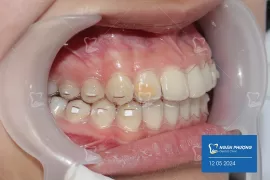 Nhược Điểm Của Niềng Răng Trong Suốt