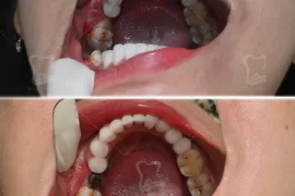 Nhược Điểm Của Trồng Răng Implant