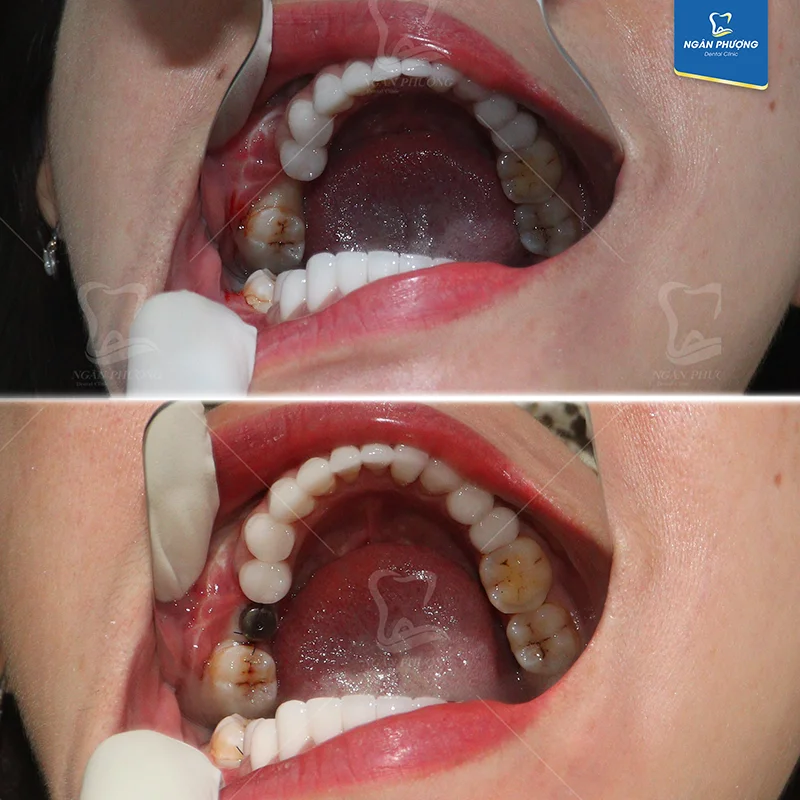 nhược điểm của trồng răng implant