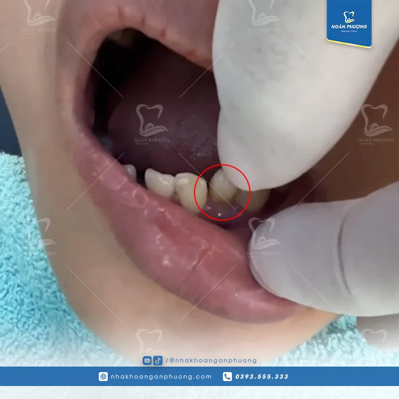 răng sữa ở người trưởng thành