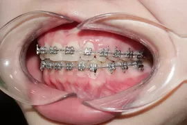 Tác Dụng Của Dây Cung