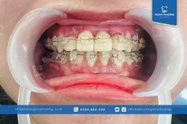 Nhược Điểm Của Niềng Răng Mắc Cài