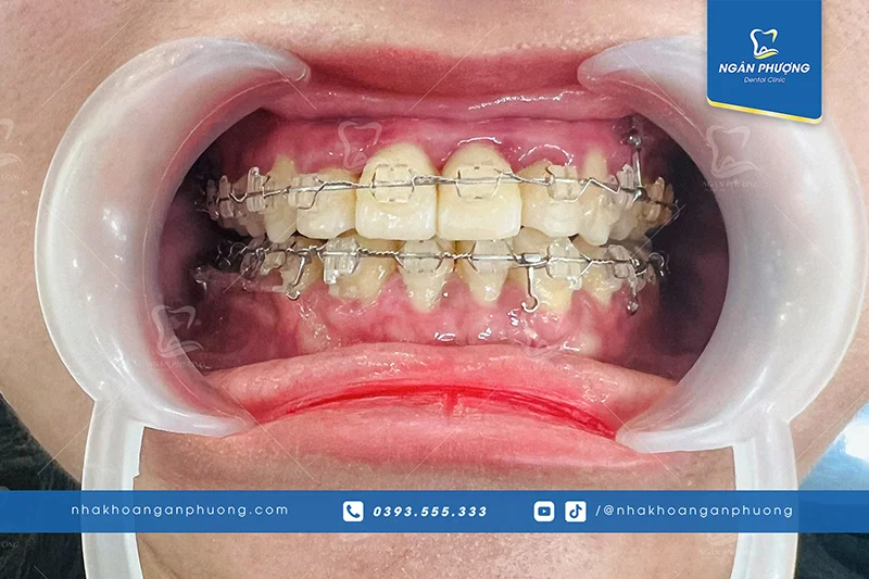 nhược điểm của niềng răng mắc cài