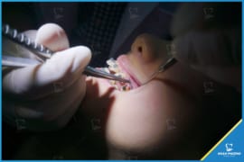 Quá trình etching trong chỉnh nha để làm gì