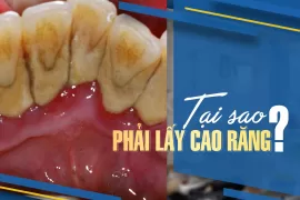 Lấy Cao Răng Không Làm Hỏng Răng