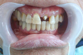 Trồng Implant Ở Răng Cửa Cần Lưu Ý Những Gì