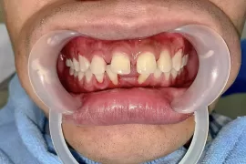 Thiếu răng có thể niềng răng được không?