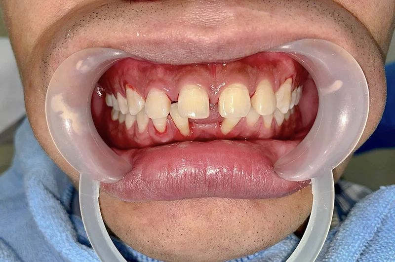 thiếu răng có thể niềng răng được không