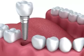Ảnh hưởng của implant đến chụp cộng hưởng từ (MRI)