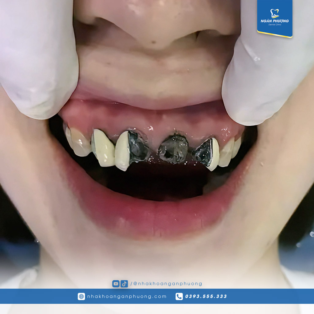 dấu hiệu răng sứ bị hỏng cần đi khám ngay