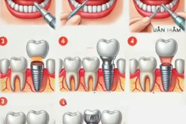 Quy Trình Trồng Răng Implant tại Nha khoa Ngân Phượng 2025