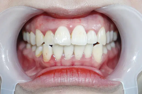 4 giai đoạn quan trọng khi niềng